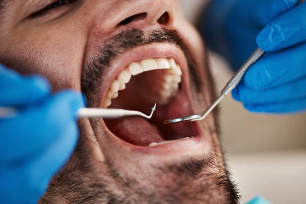 Best Emergency Tooth Extraction in Perry, LA